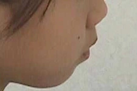 永久歯を抜かずに出っ歯を治したい方に!【上顎前突・下顎前歯叢生の症例紹介】