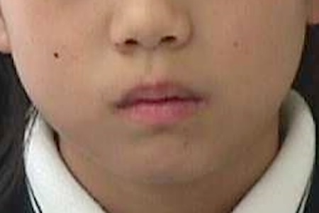 永久歯を抜かずに出っ歯を治したい方に!【上顎前突・下顎前歯叢生の症例紹介】