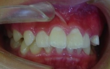 Before