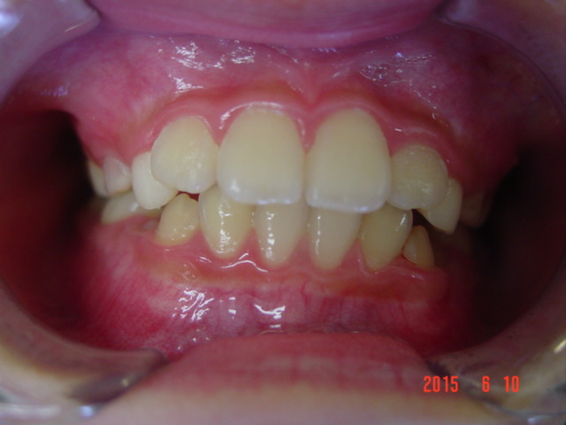 Before