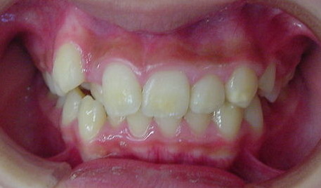 Before