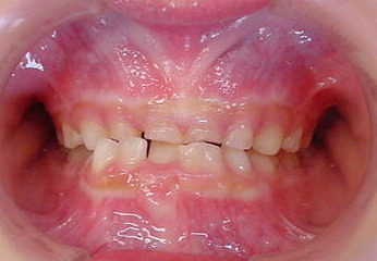 Before