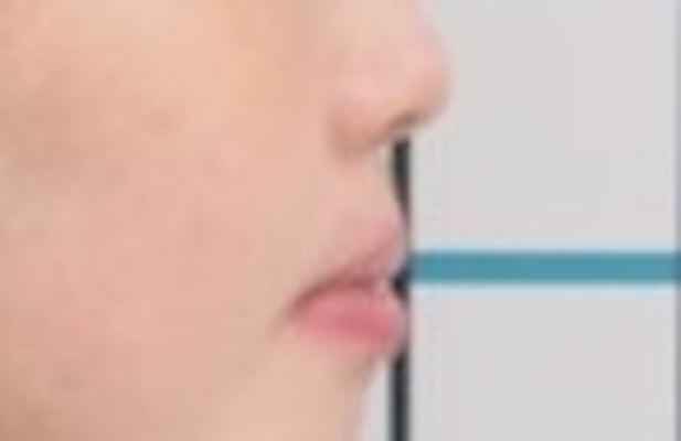 【矯正症例】成人矯正
