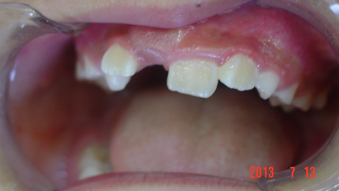 【矯正症例】左上2番3番逆転症例