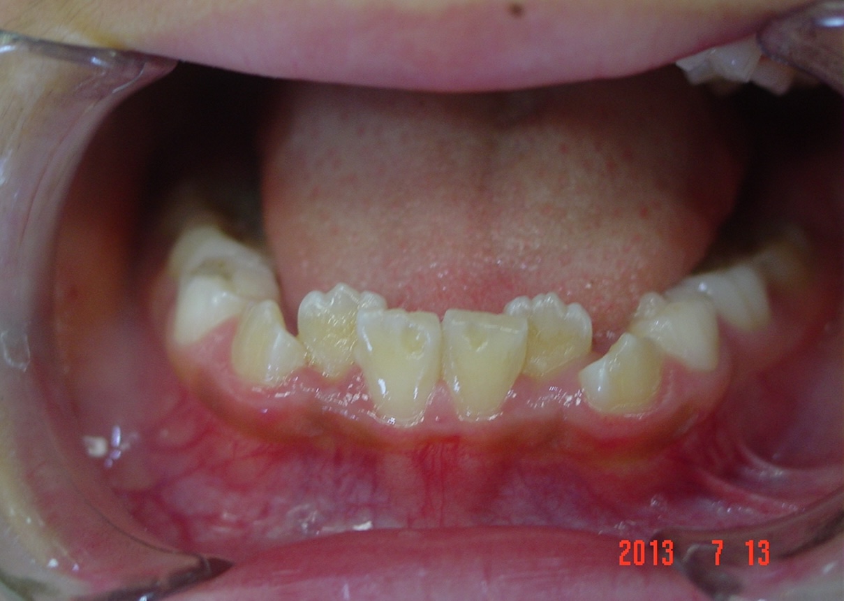 【矯正症例】左上2番3番逆転症例