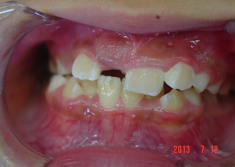 【矯正症例】左上2番3番逆転症例