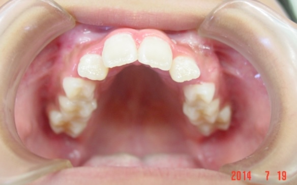 【矯正症例】上顎前突