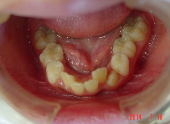 【矯正症例】上顎前突