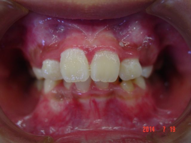 【矯正症例】上顎前突