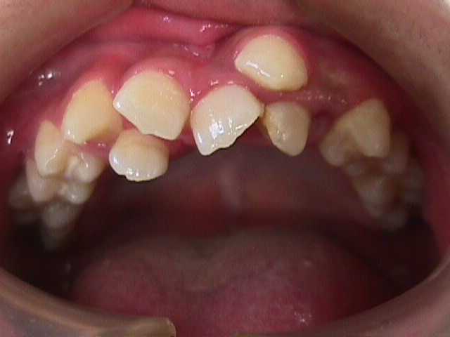 【矯正症例】左上２番３番逆転症例2