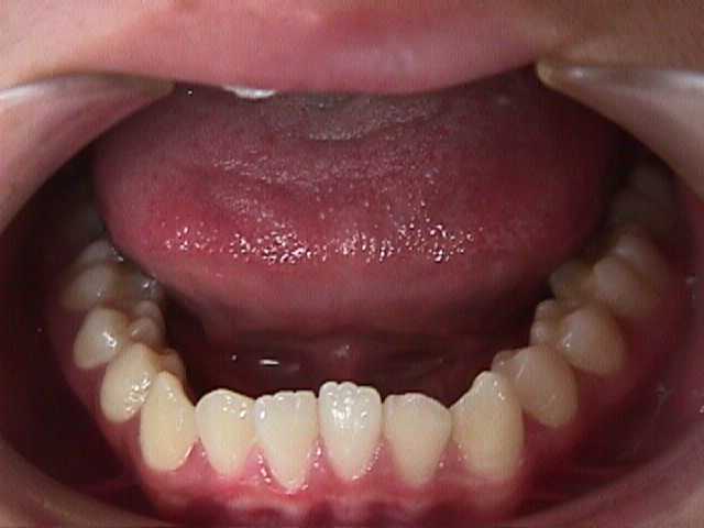 【矯正症例】左上２番３番逆転症例2