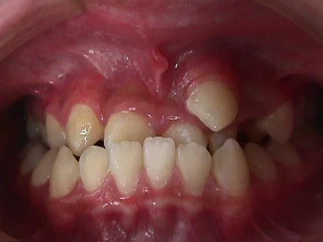 【矯正症例】左上2番3番逆転症例2