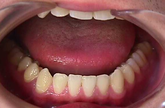 【矯正症例】左上２番３番逆転症例2