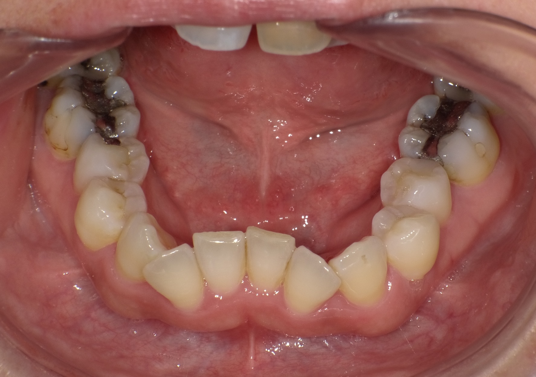 【矯正症例】らんぐい歯4