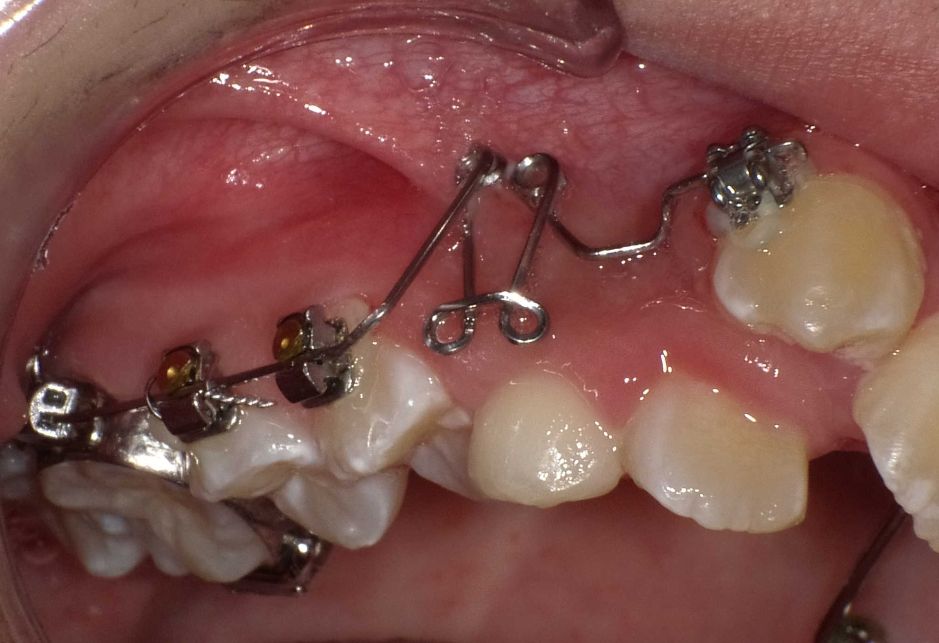 【矯正症例】左上2番3番逆転症例