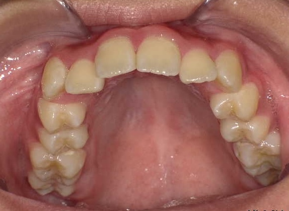 【矯正症例】上顎前突