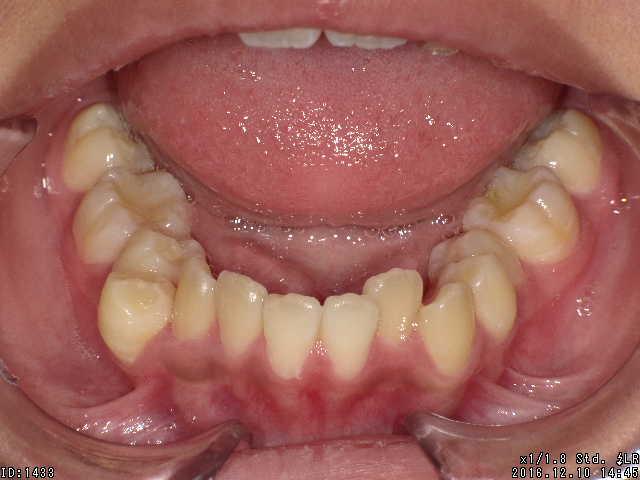 【矯正症例】上顎前突