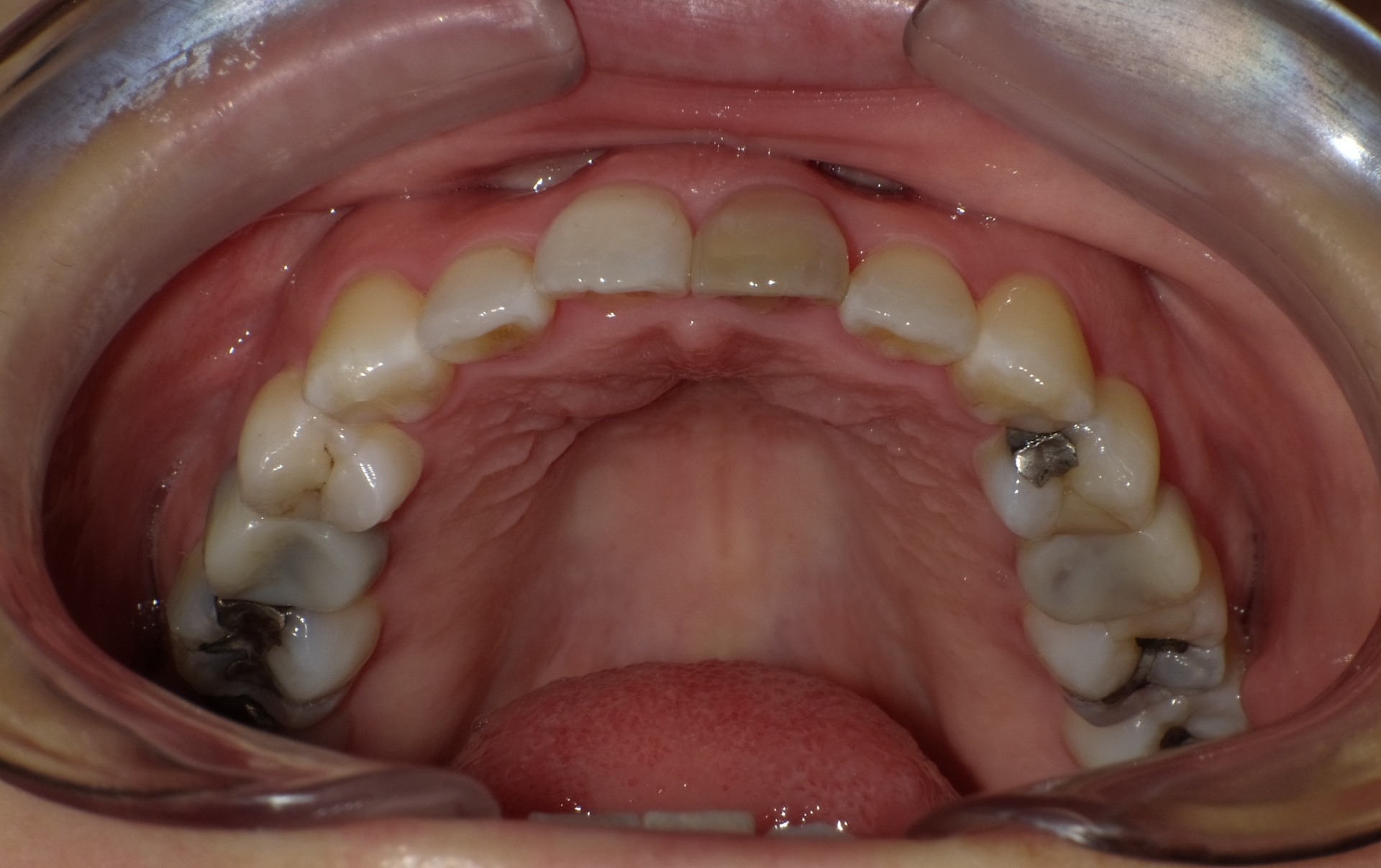 【矯正症例】らんぐい歯4