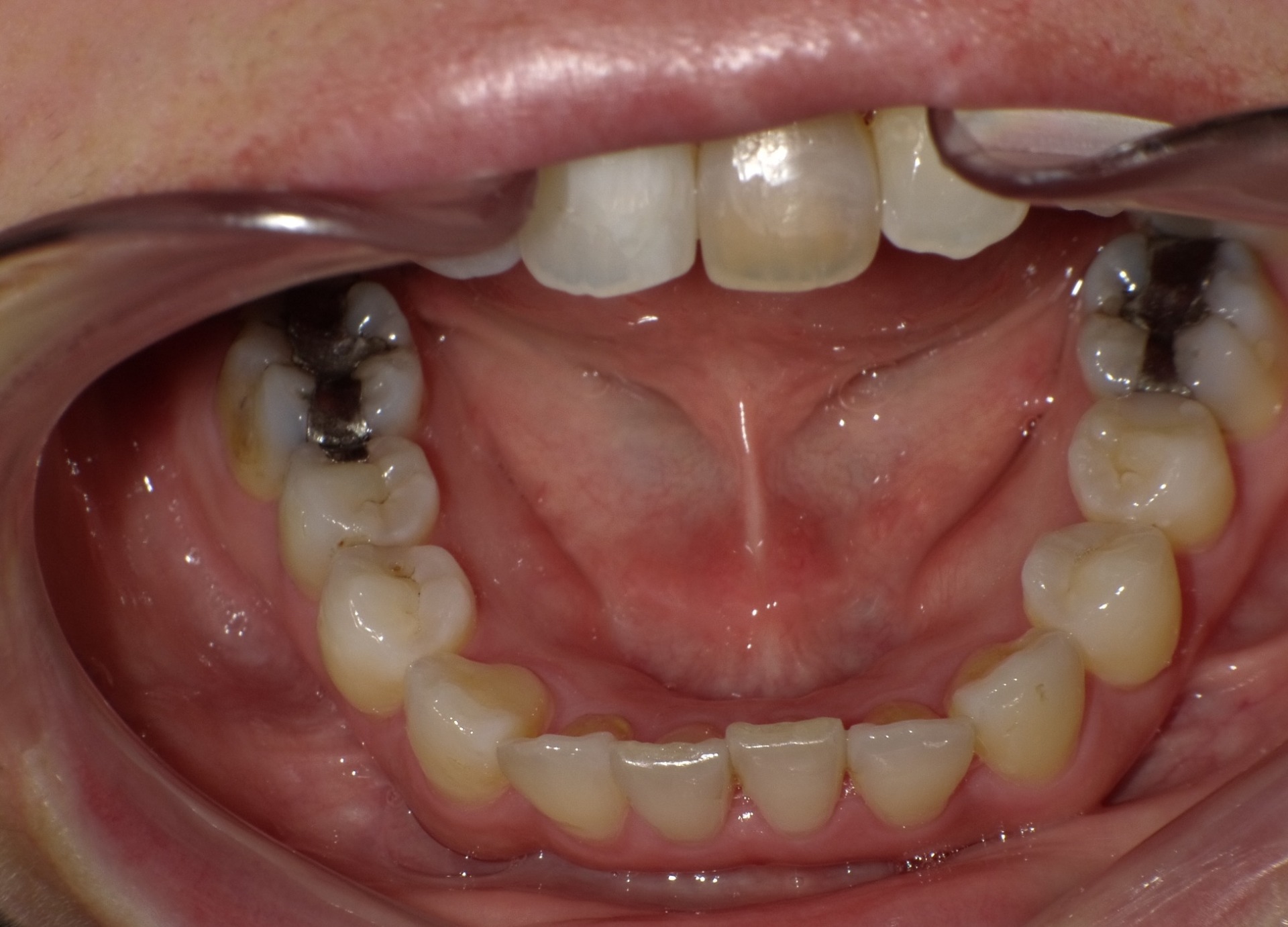 【矯正症例】らんぐい歯4