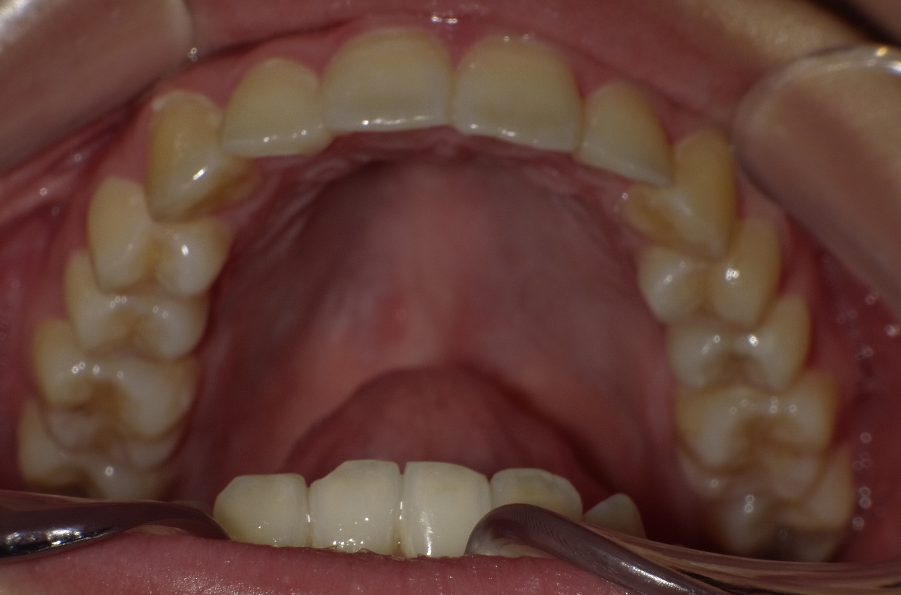 【矯正症例】上顎前突