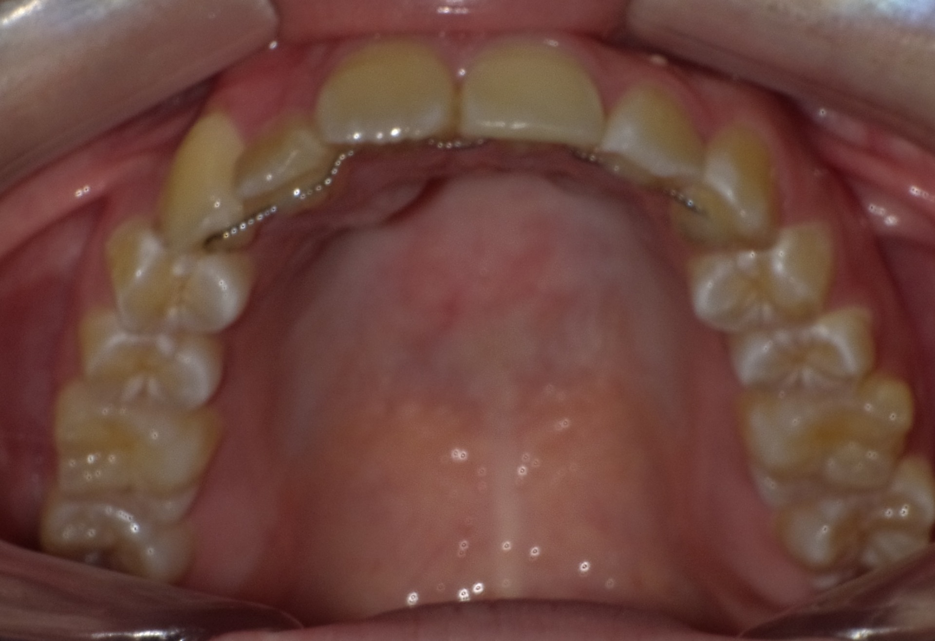 【矯正症例】左上2番3番逆転症例