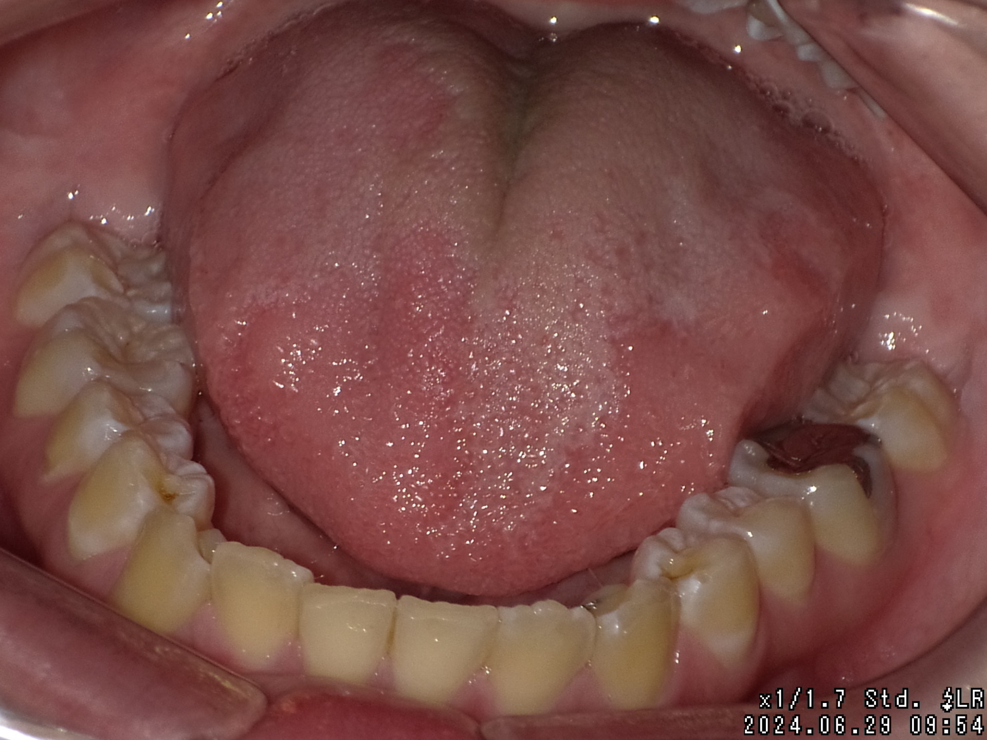 【矯正症例】左上2番3番逆転症例