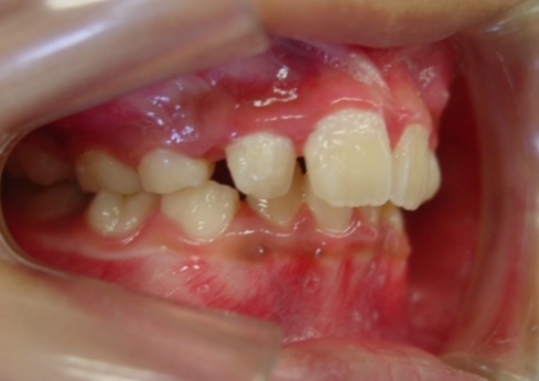 小児矯正をご希望の方へ