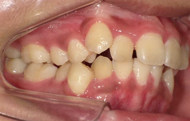 小児矯正をご希望の方へ