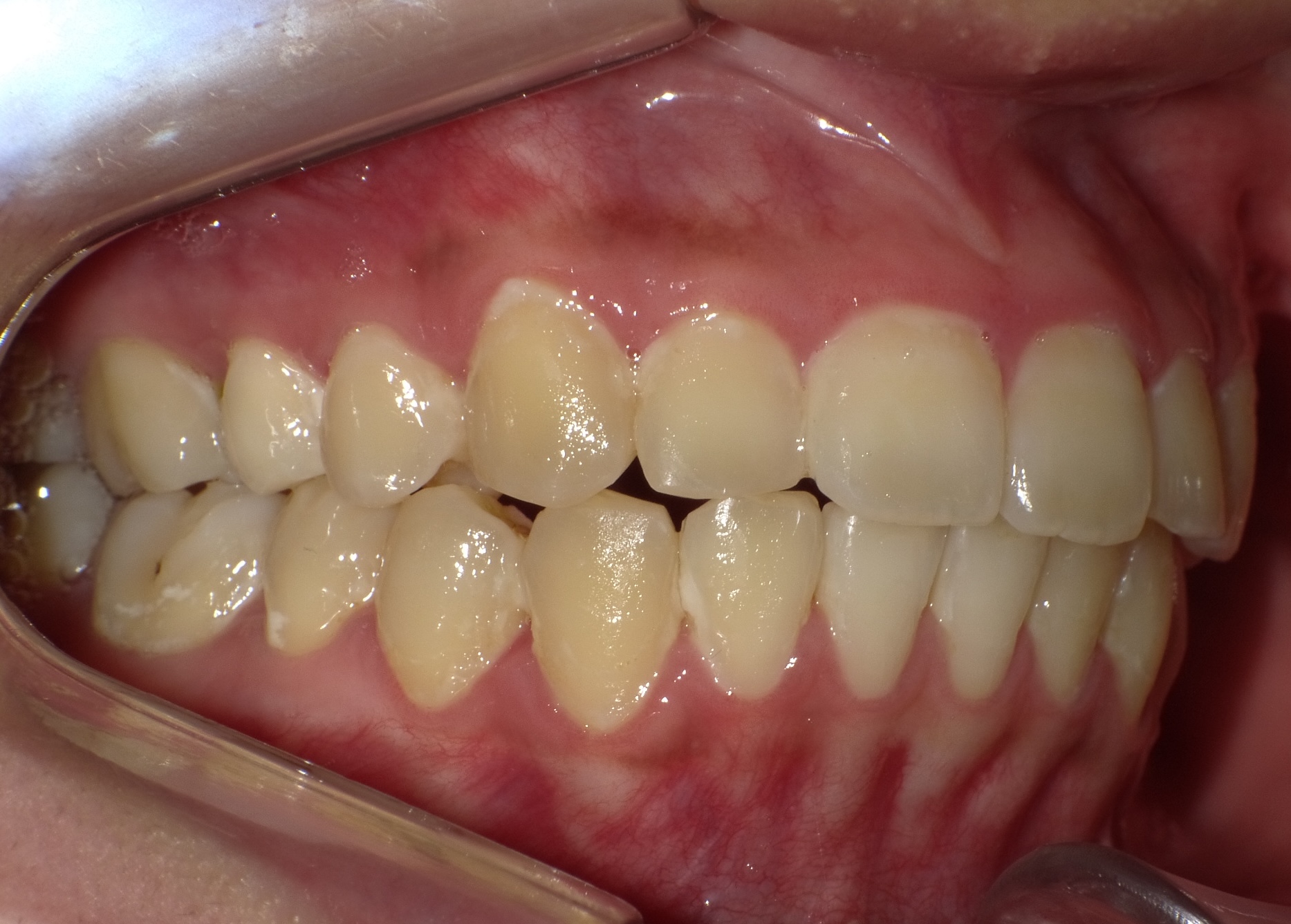 小児矯正をご希望の方へ