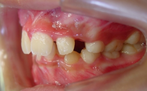 小児矯正をご希望の方へ