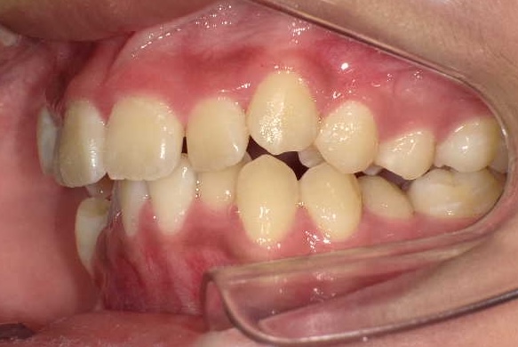 小児矯正をご希望の方へ