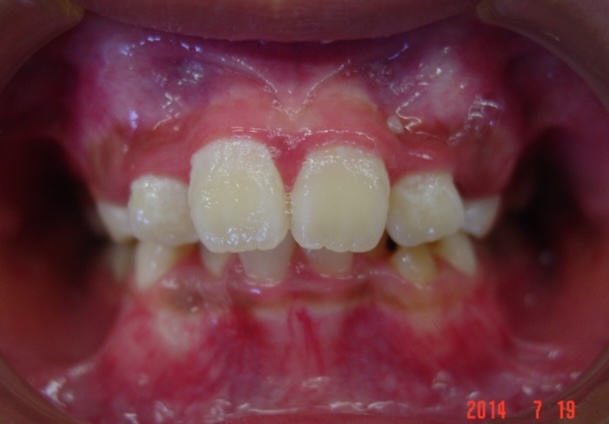 小児矯正をご希望の方へ