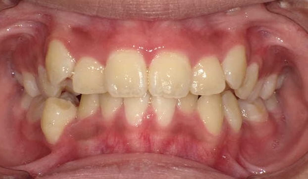 小児矯正をご希望の方へ