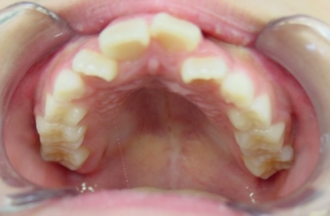 【矯正症例】上顎前突2