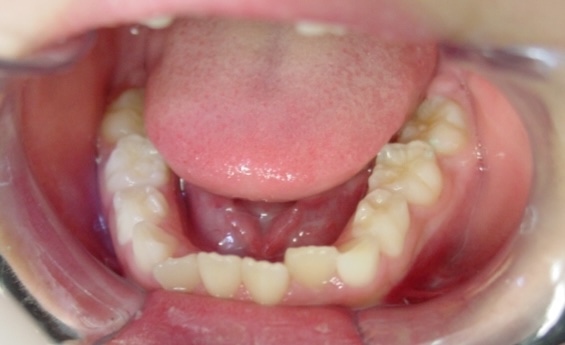 【矯正症例】上顎前突2