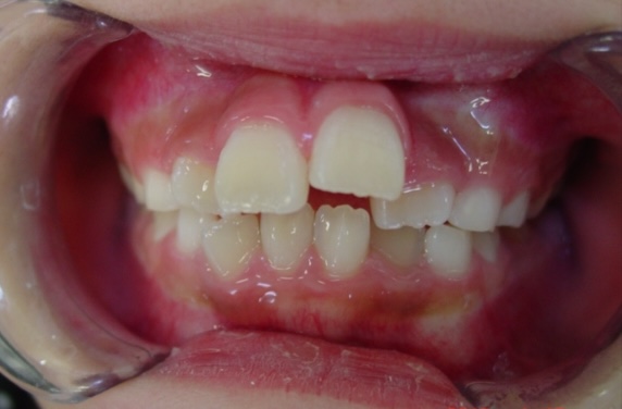 【矯正症例】上顎前突2