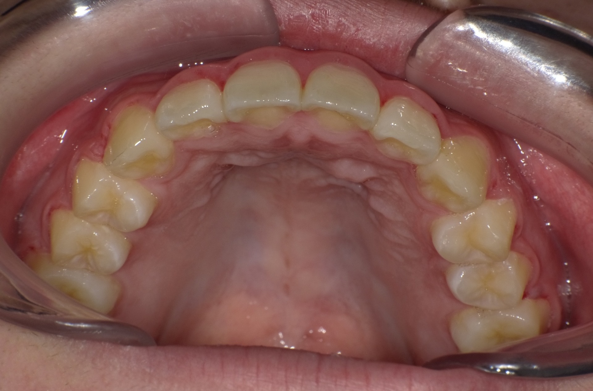 【矯正症例】上顎前突2