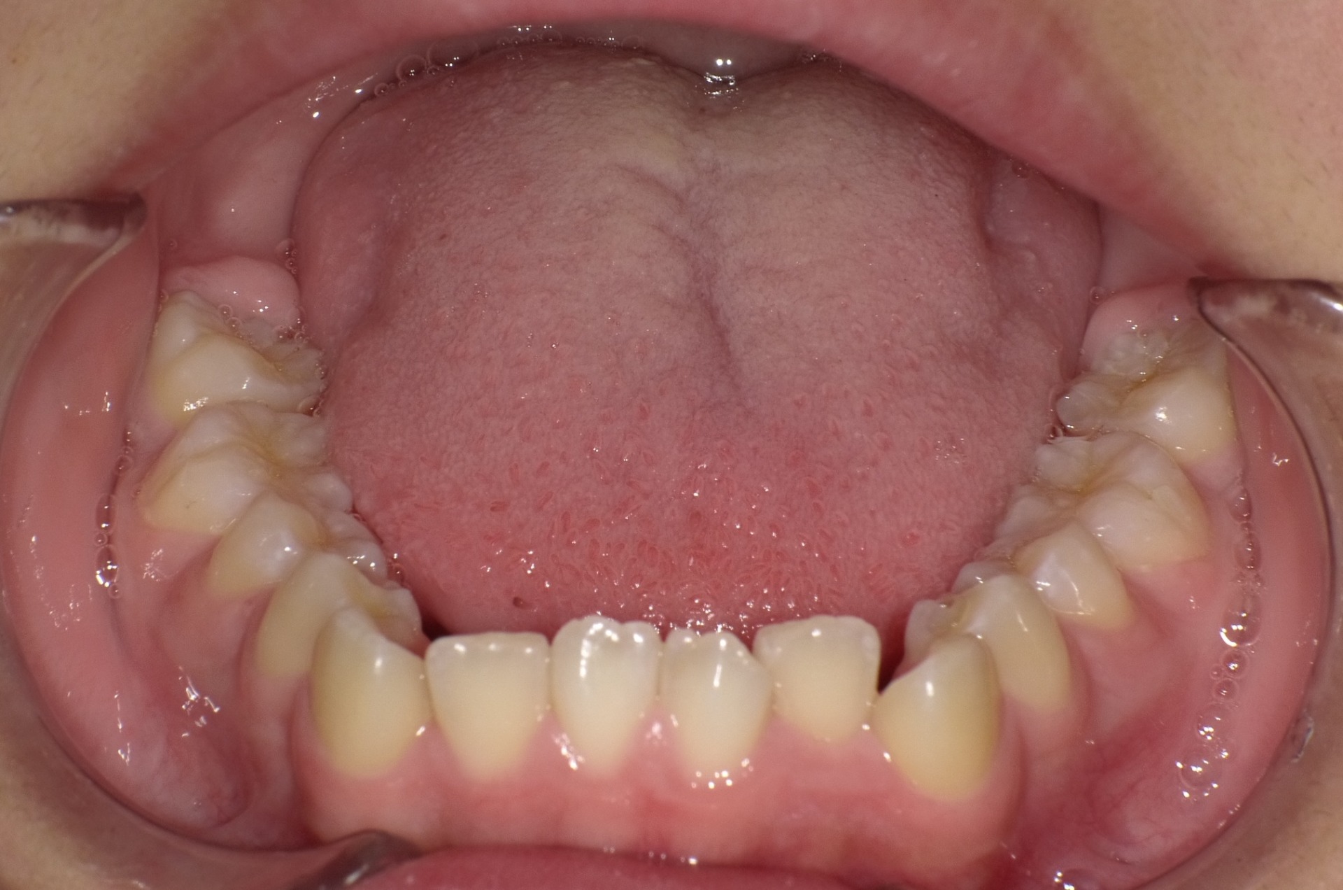 【矯正症例】上顎前突2