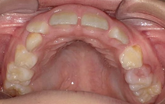 【矯正症例】上顎前突 過蓋咬合