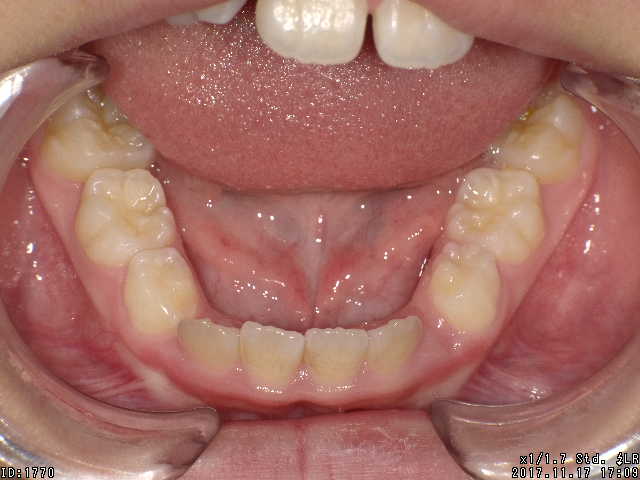 【矯正症例】上顎前突 過蓋咬合