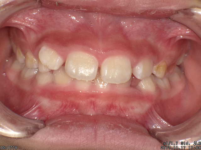 【矯正症例】上顎前突 過蓋咬合