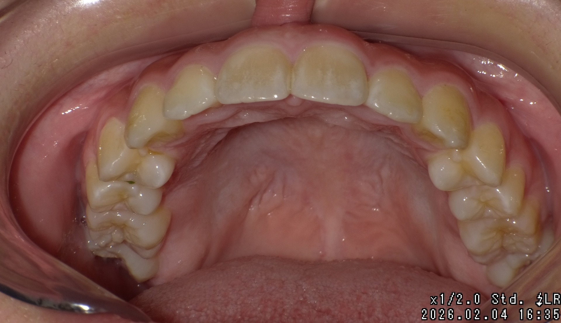 【矯正症例】上顎前突 過蓋咬合