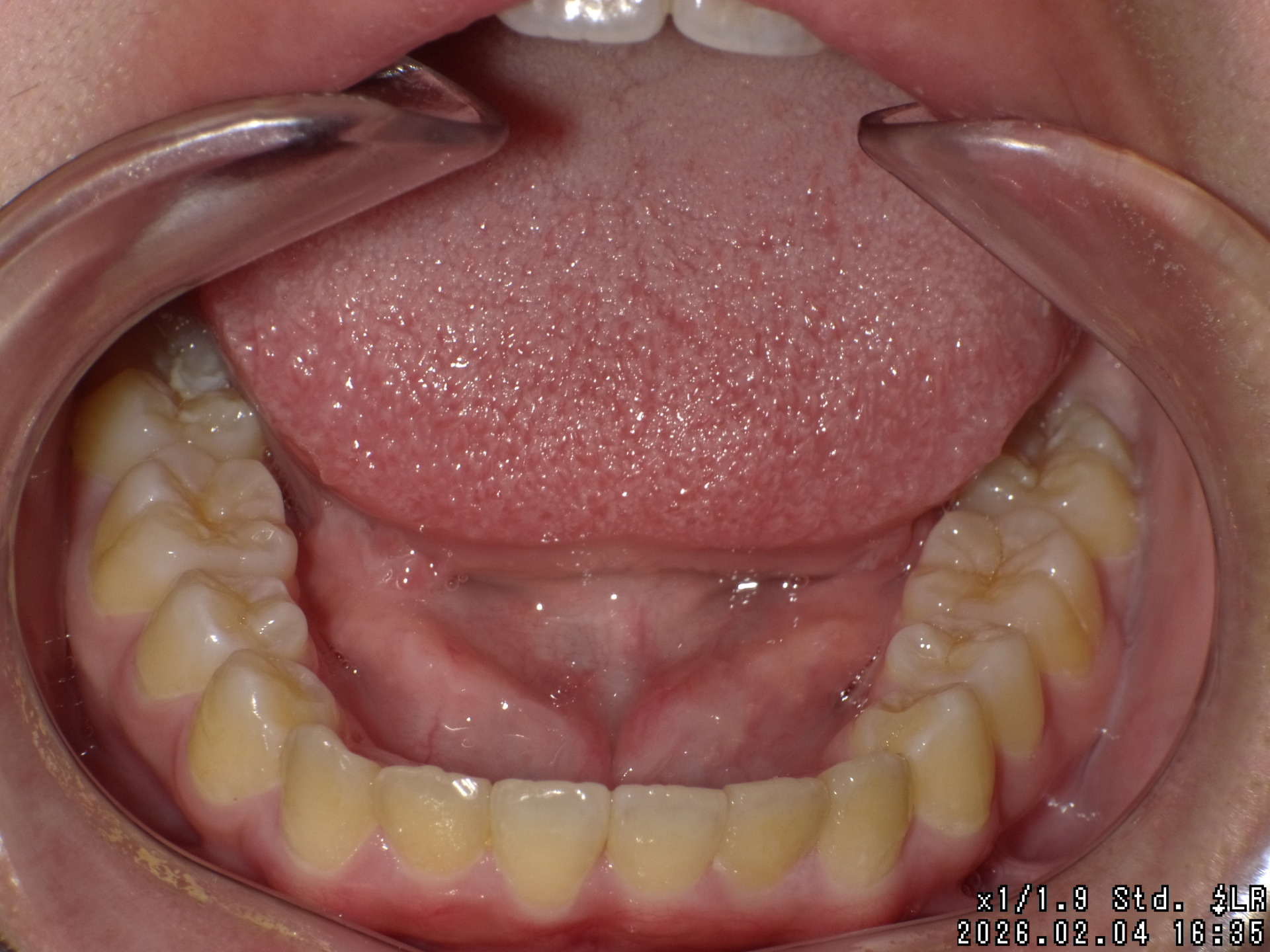 【矯正症例】上顎前突 過蓋咬合