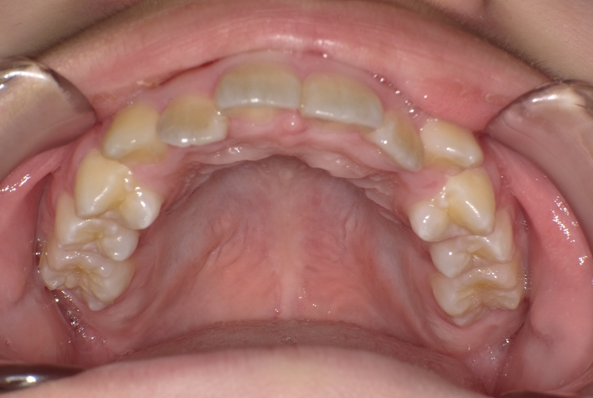 【矯正症例】上顎前突 過蓋咬合