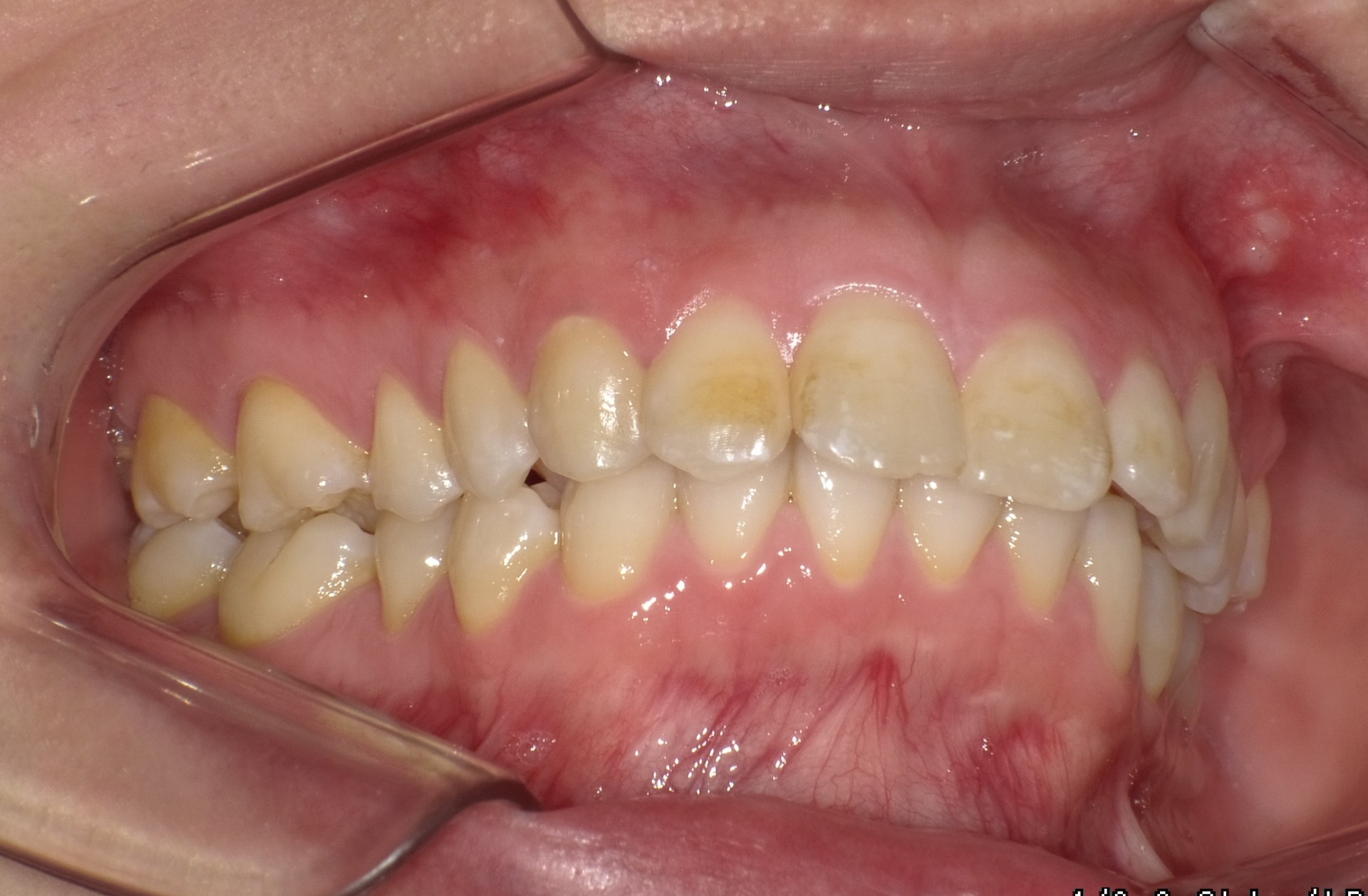 【矯正症例】成人矯正3