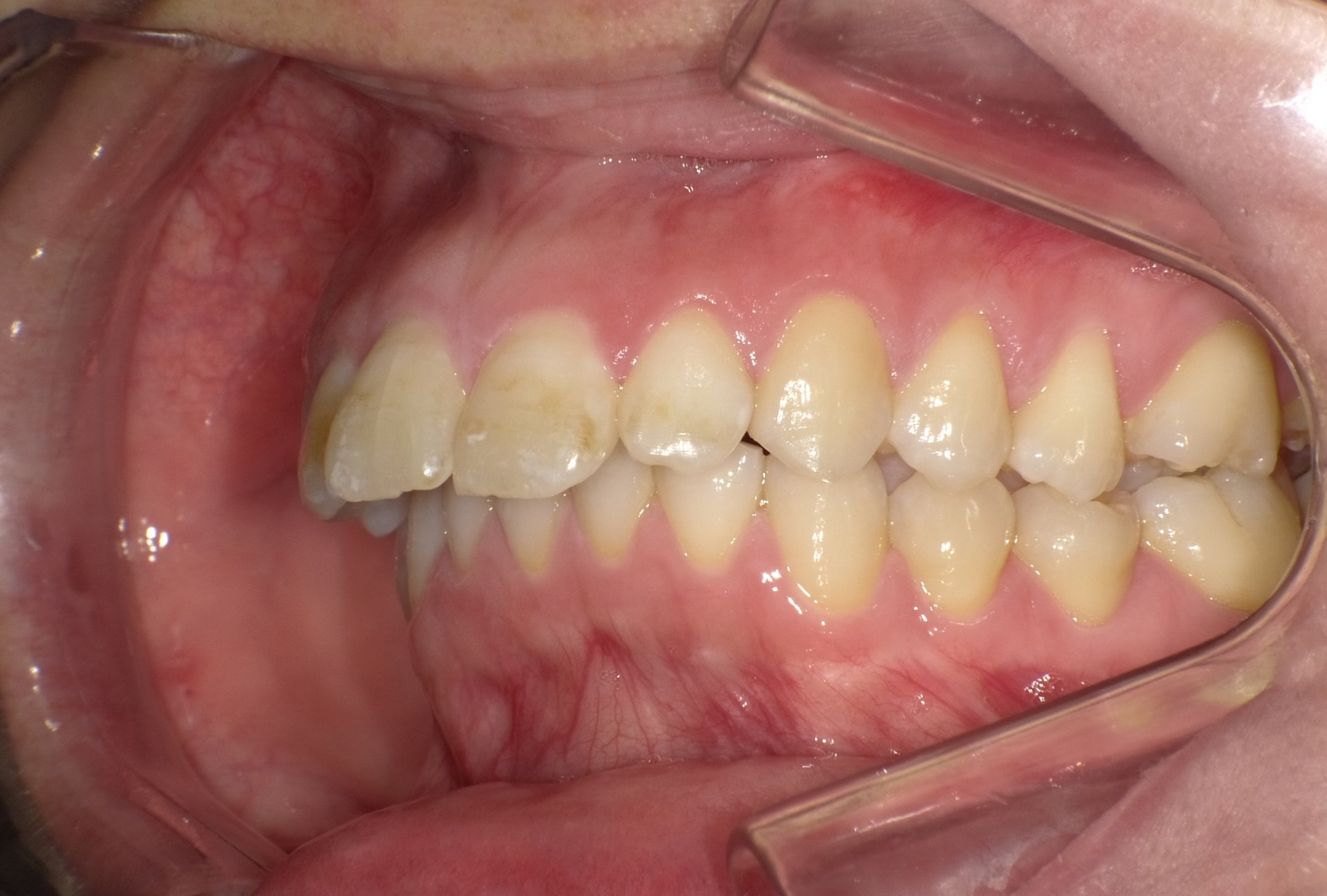 【矯正症例】成人矯正3