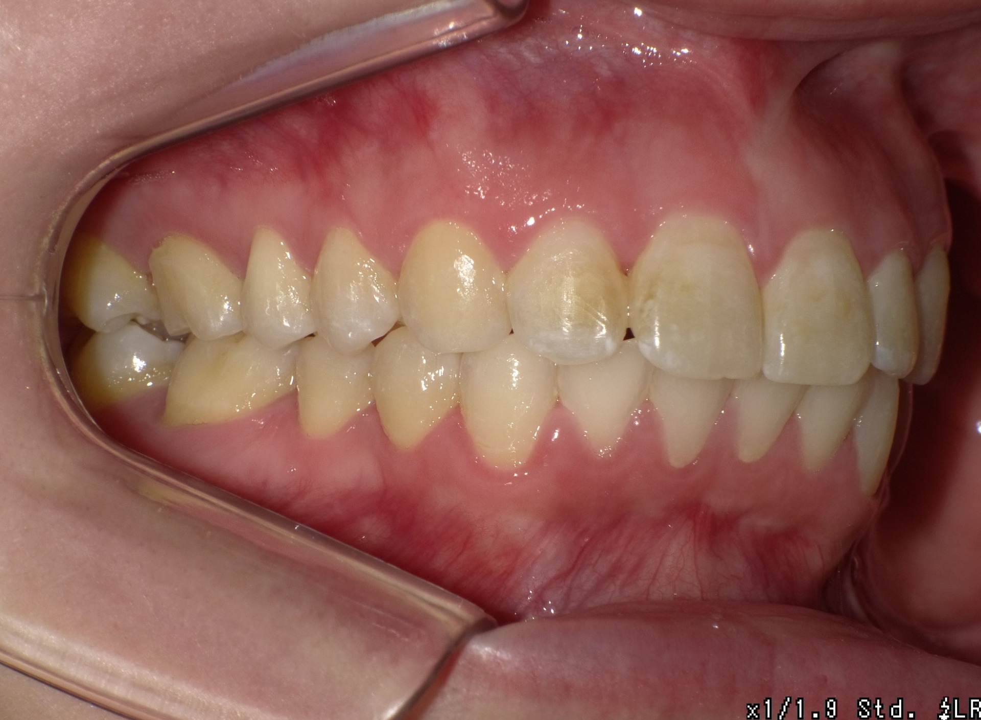 【矯正症例】成人矯正3