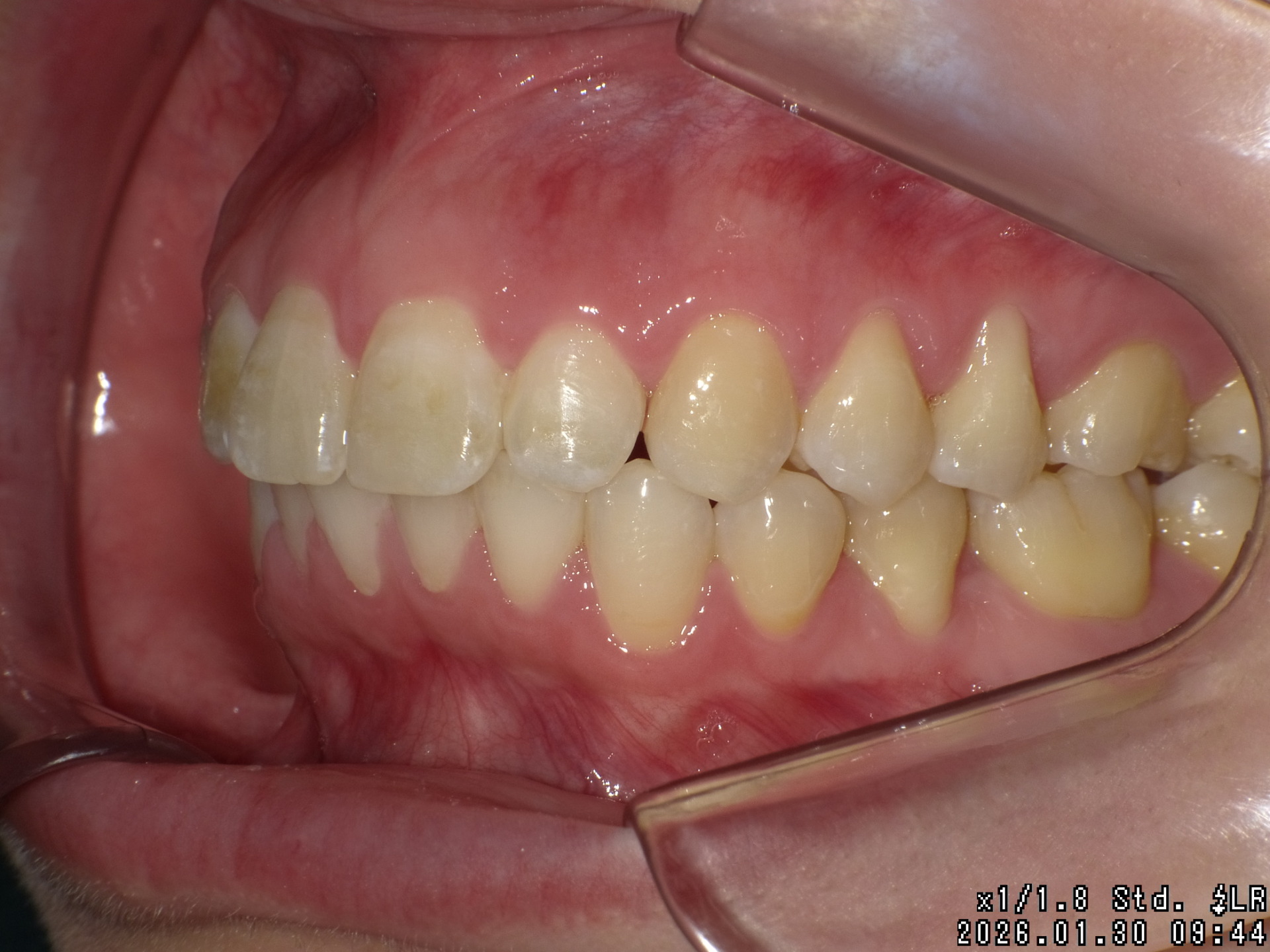 【矯正症例】成人矯正3