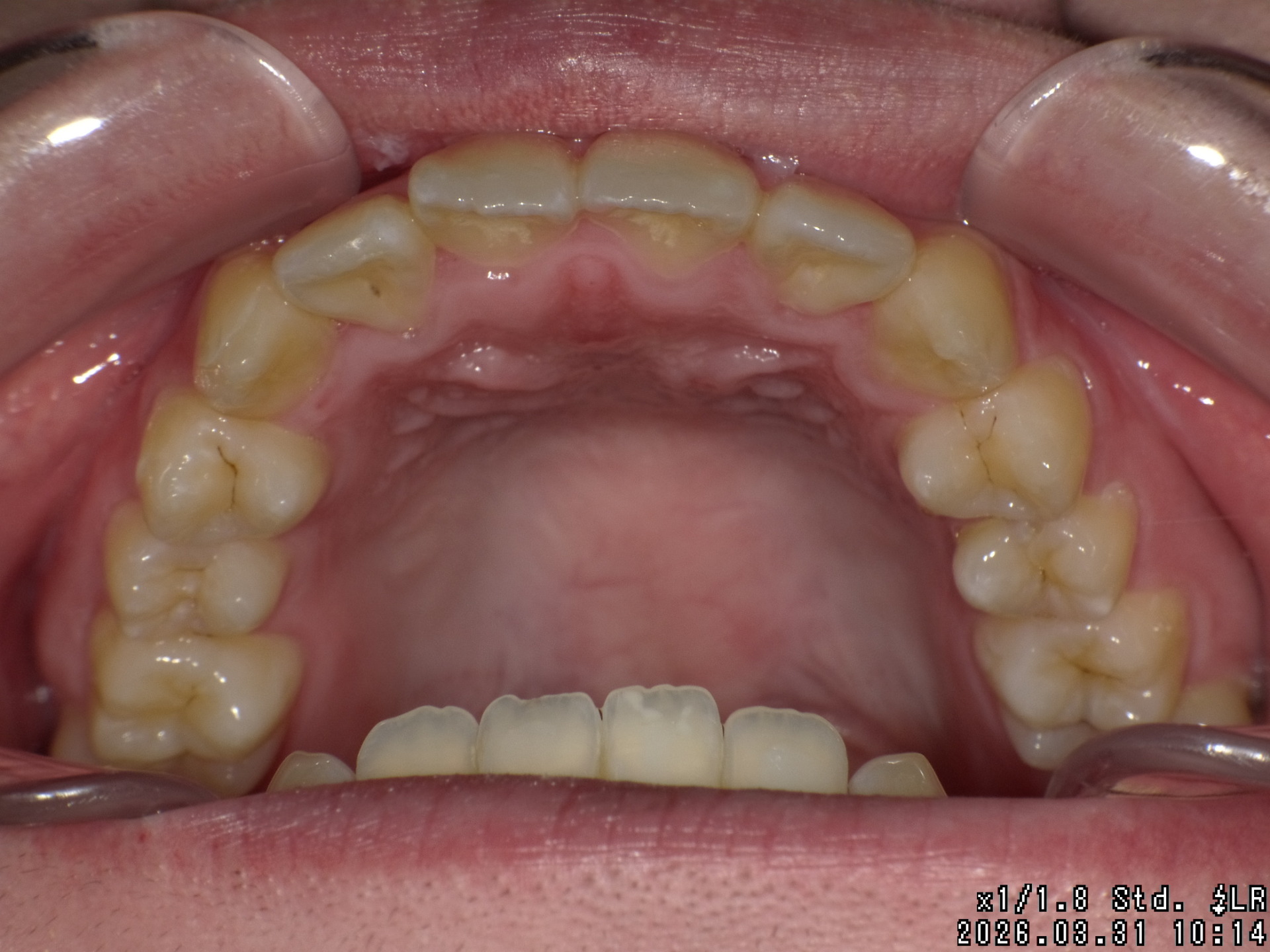 【矯正症例】成人矯正4