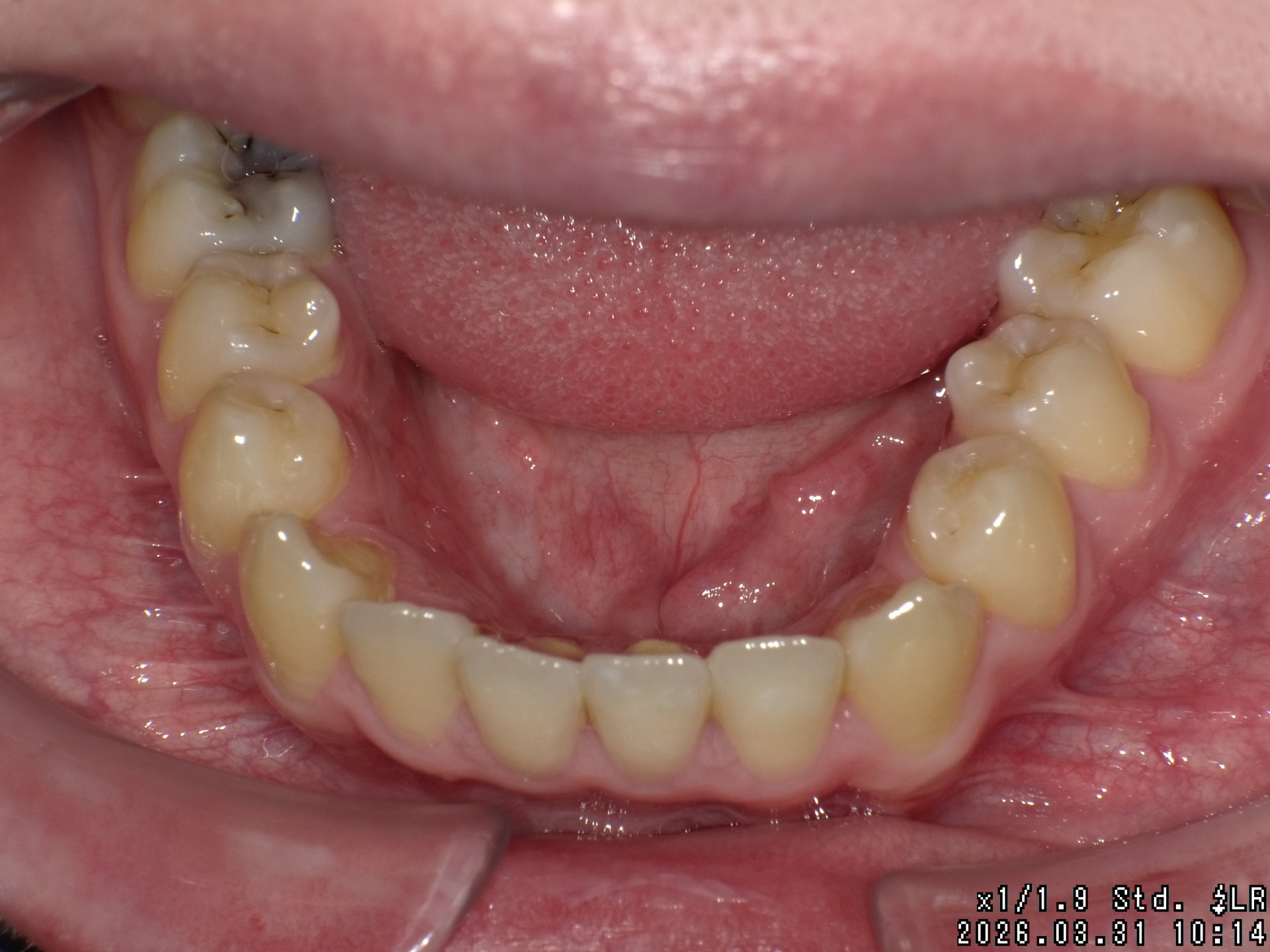 【矯正症例】成人矯正4